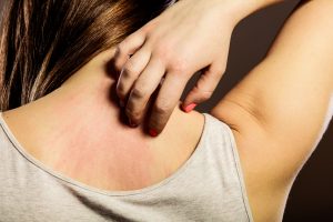 4 recomendaciones para combatir la dermatitis y la piel atópica en invierno