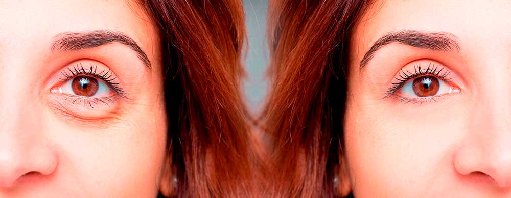 ¿Tienes ojeras? Estas son las razones.